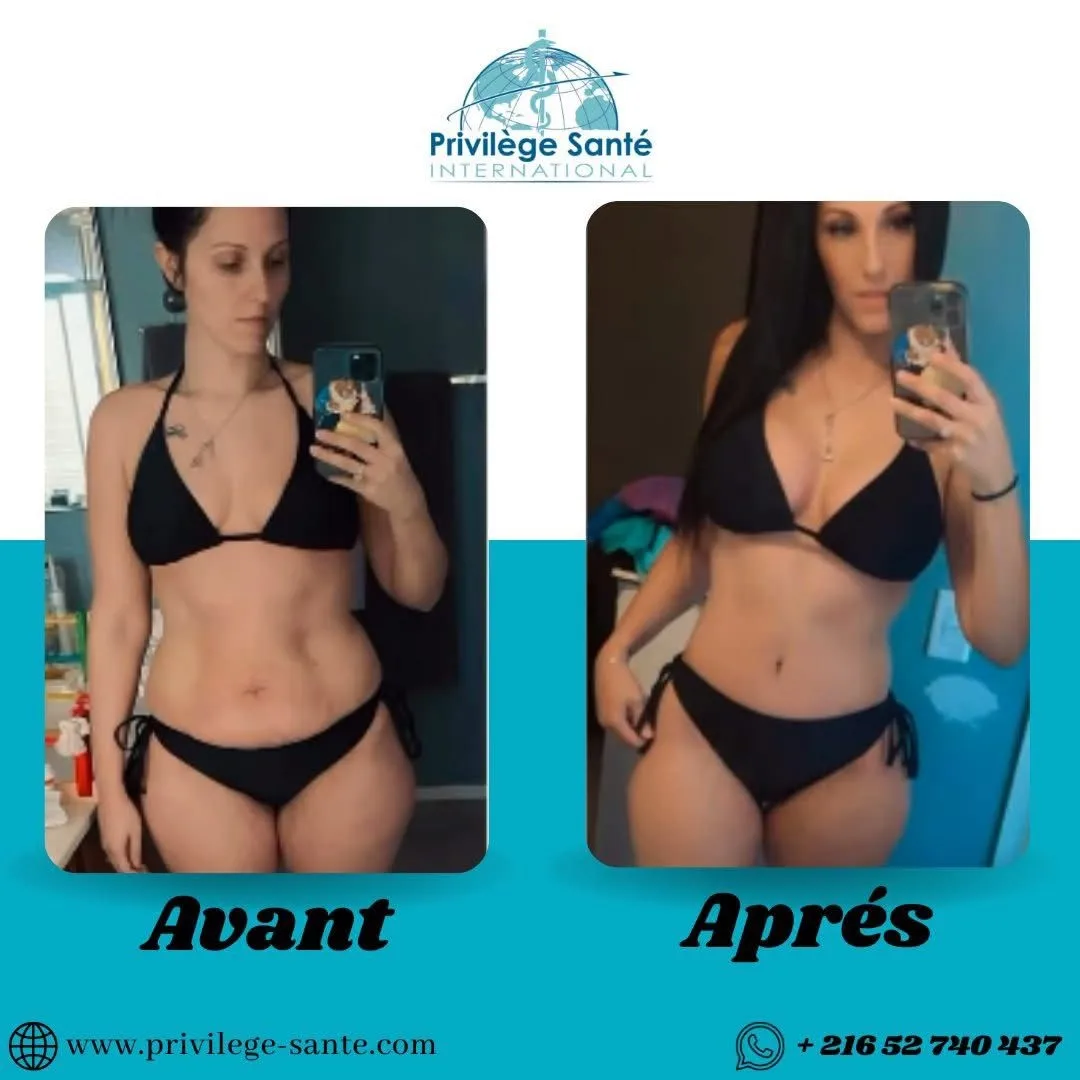 Mini abdominoplastie Tunisie
