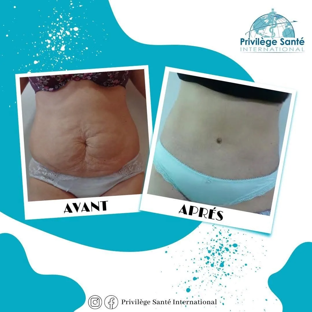 Mini abdominoplastie Tunisie