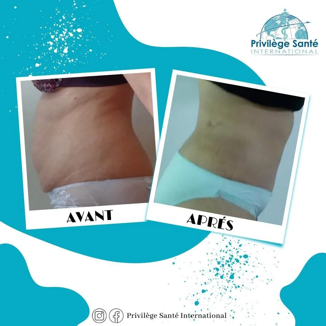 Abdominoplastie inversée Tunisie