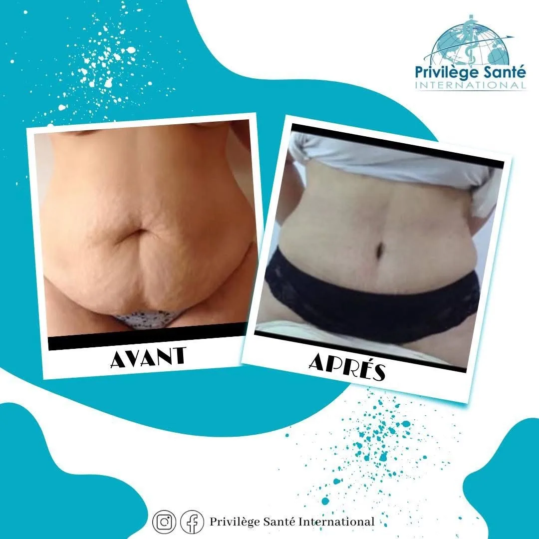 Abdominoplastie Tunisie