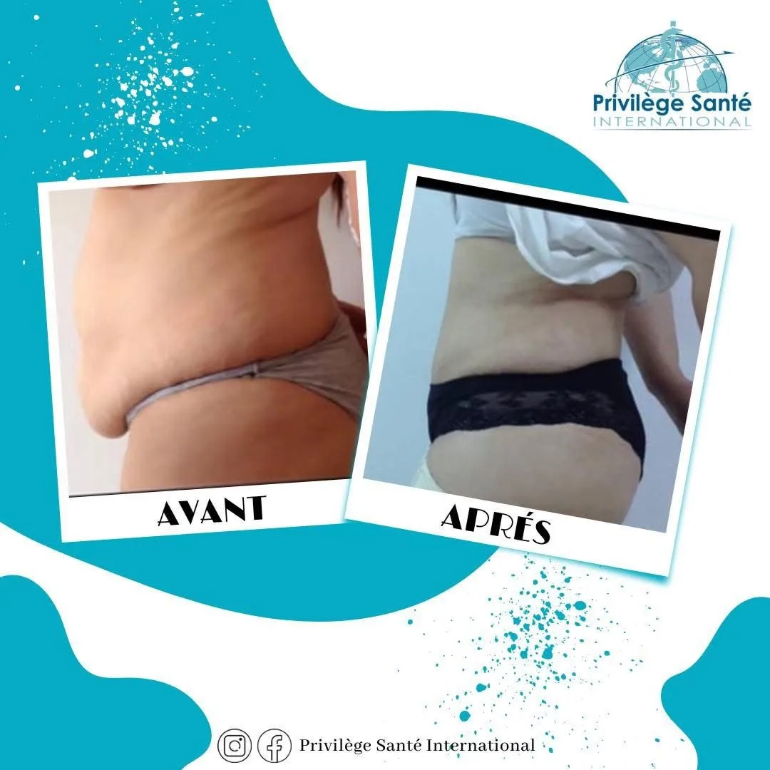 Abdominoplastie Tunisie