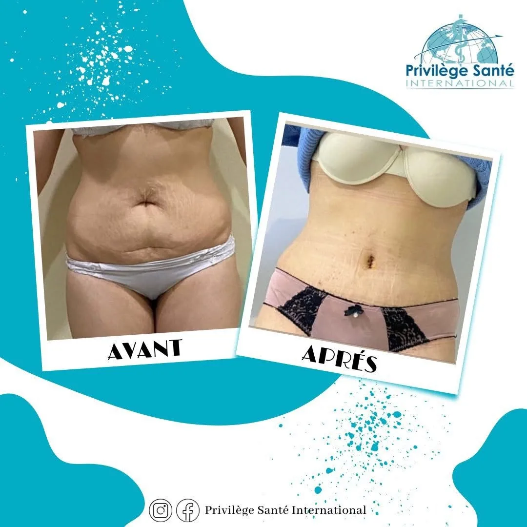 Mini abdominoplastie Tunisie