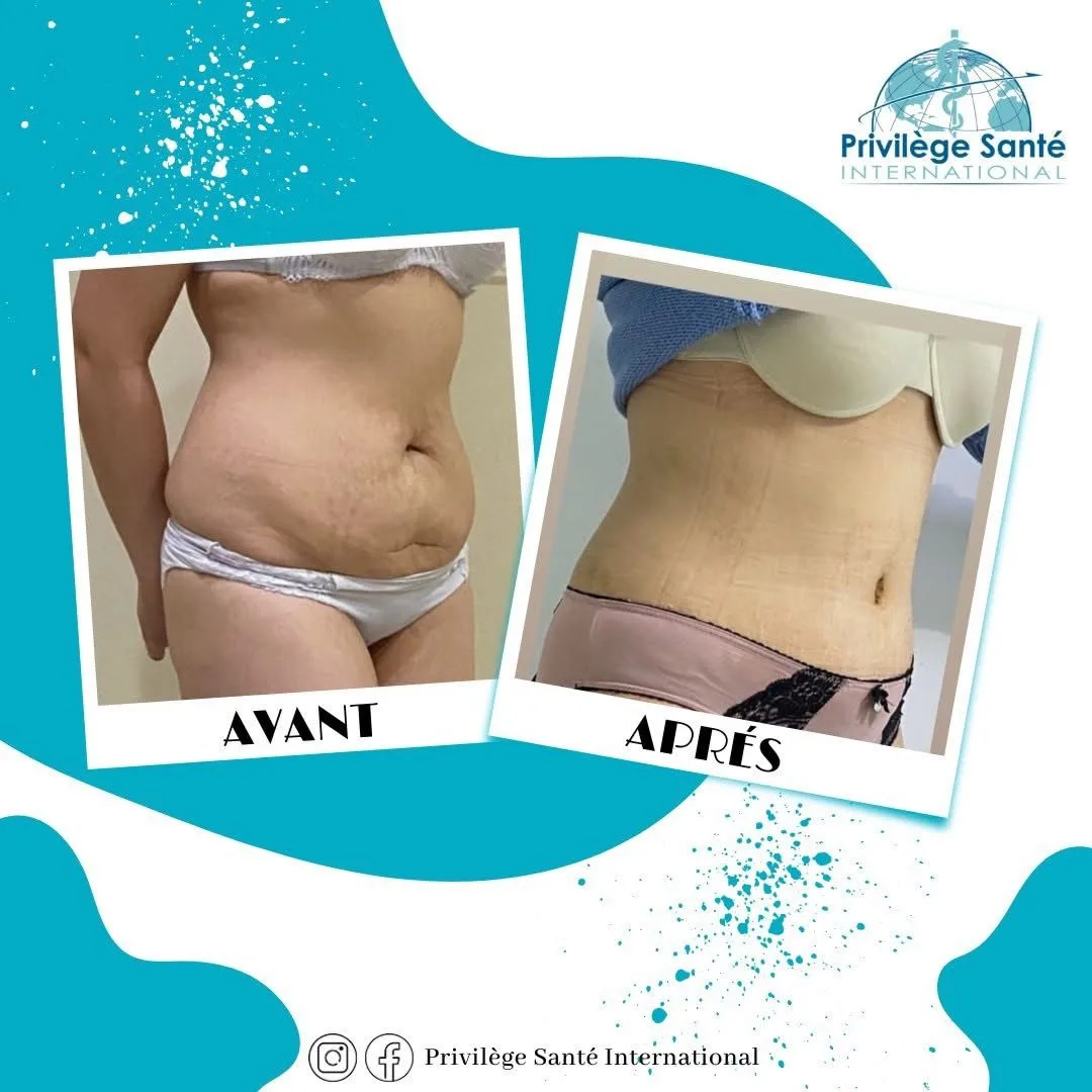 Abdominoplastie inversée Tunisie