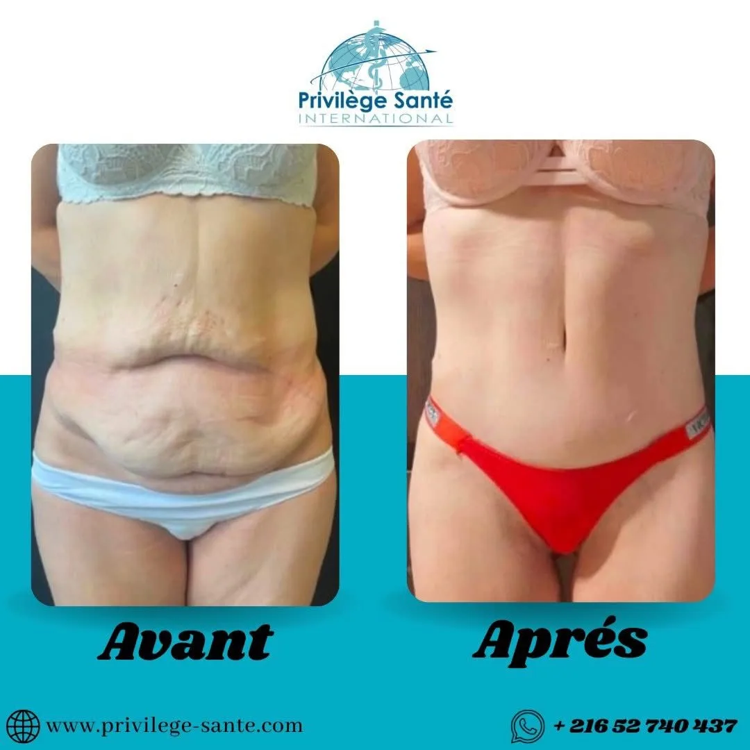 Abdominoplastie inversée Tunisie