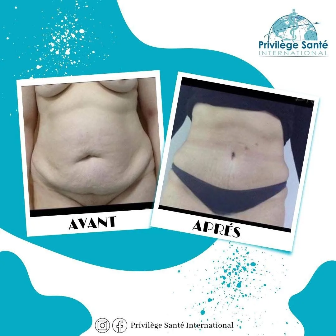 Abdominoplastie Tunisie