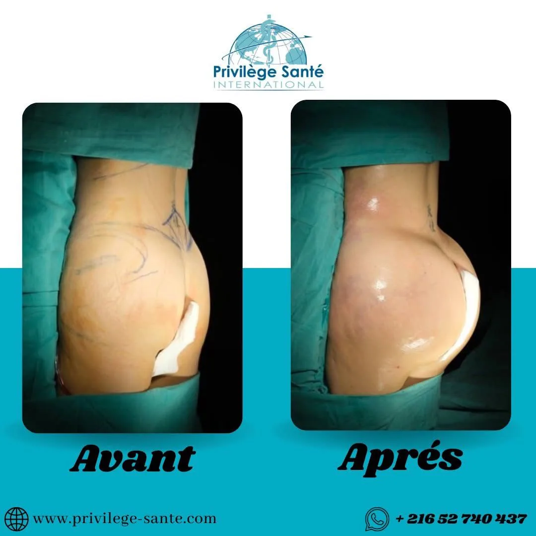 Chirurgie BBL Tunisie