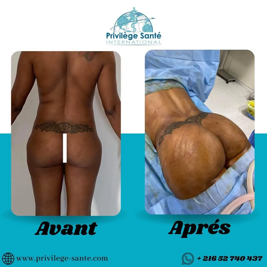 Chirurgie BBL Tunisie