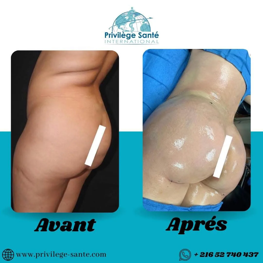 Chirurgie BBL Tunisie