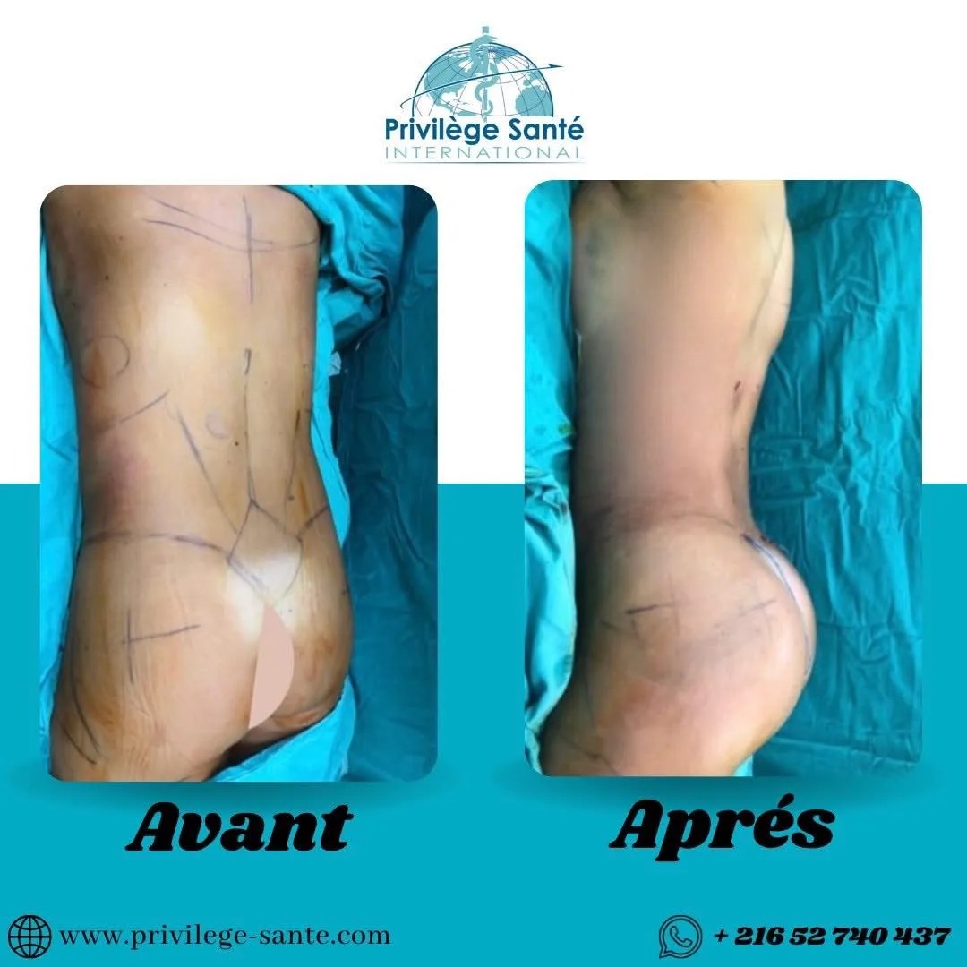 Chirurgie BBL Tunisie