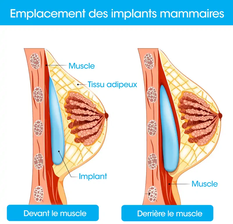 Emplacement implants mammaires Tunisie