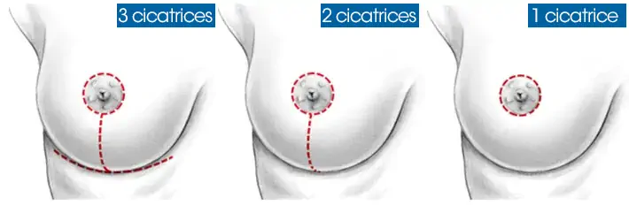 Breast lift scars Tunisia