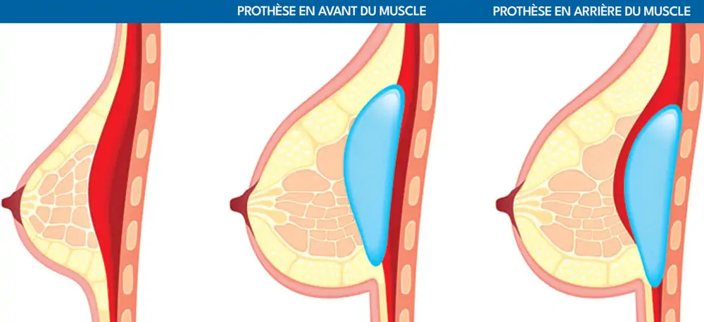 Breast implants Tunisia