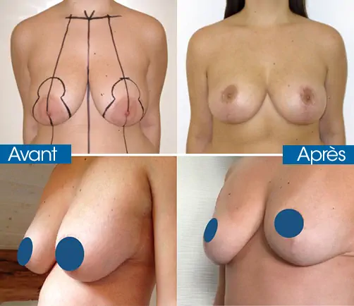 Breast reduction tunisia