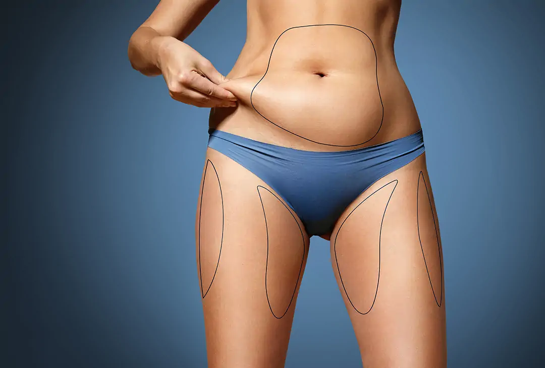 Liposuction Tunisia