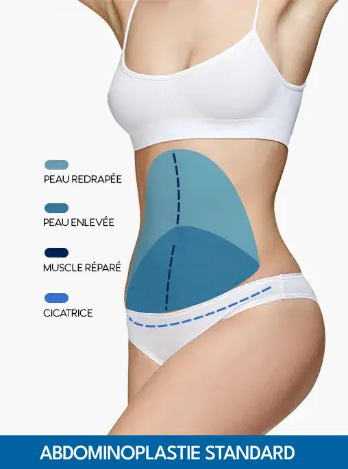 Abdominoplastie Tunisie