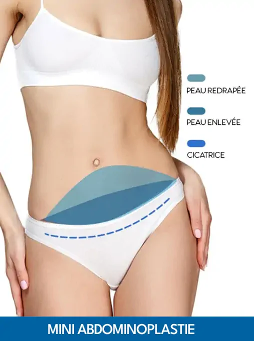 Mini abdominoplastie Tunisie