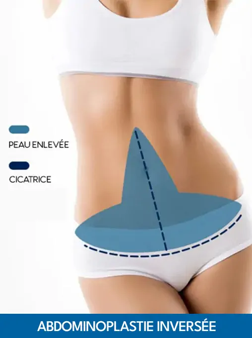 Inverted Tummy Tuck Tunisia