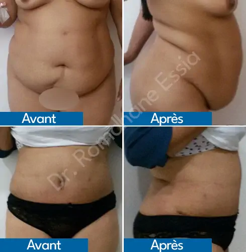 Abdominoplastie Tunisie