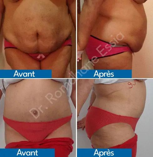 Mini abdominoplastie Tunisie