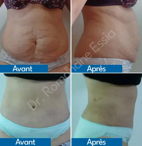 Abdominoplastie inversée Tunisie