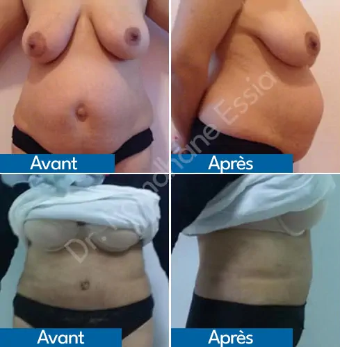 Tummy tuck Tunisia