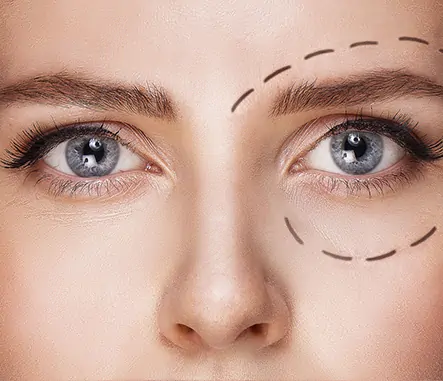 Blepharoplasty Tunisia