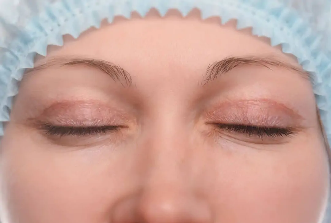 Blepharoplastie Tunisie