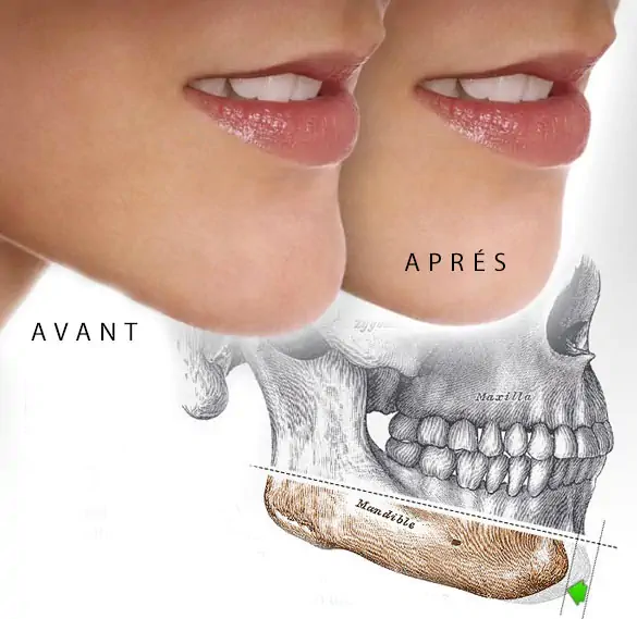 Chin surgery Tunisia