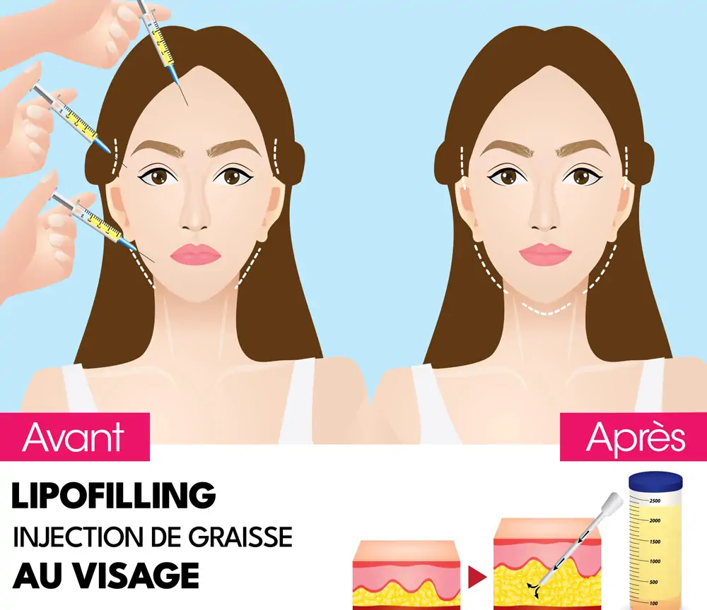 Lipofilling visage Tunisie