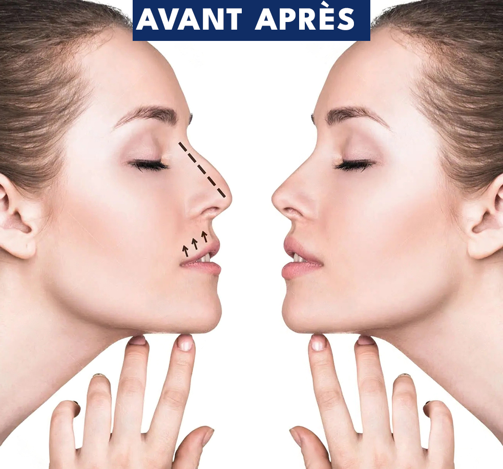 Profiloplastie Tunisie