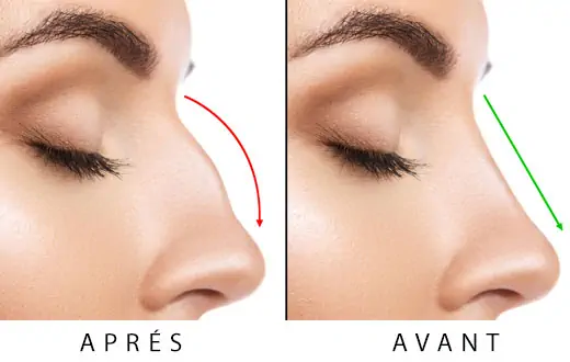 Rhinoplastie Tunisie