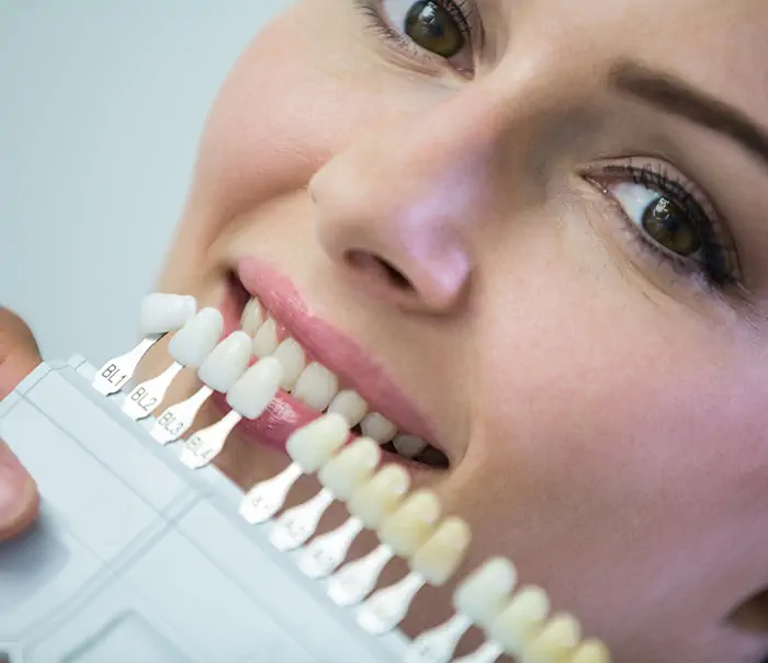 Facette dentaire pour un sourire esthétique blanc et uniforme