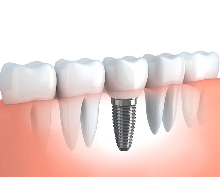 Dental implants Turkey