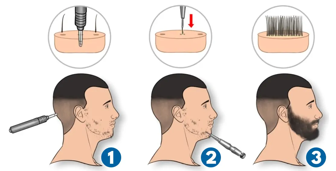 Beard transplant Tunisia