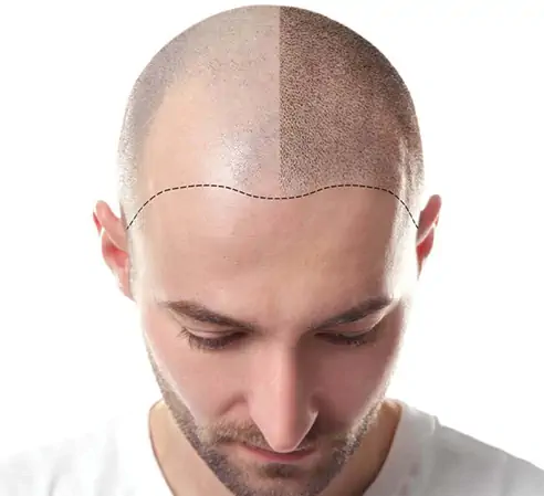 Hair transplant Tunisia