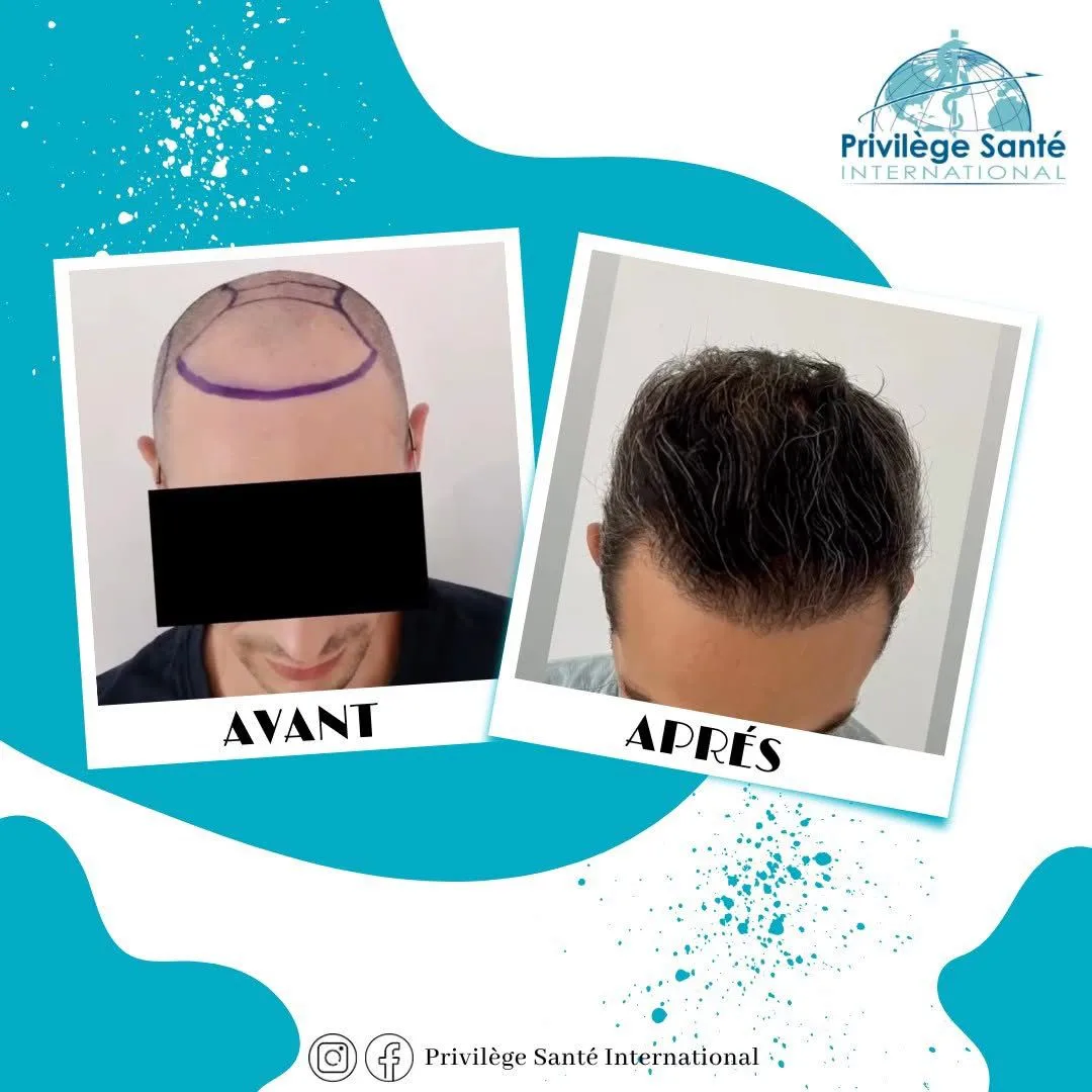 Greffe de cheveux Tunisie