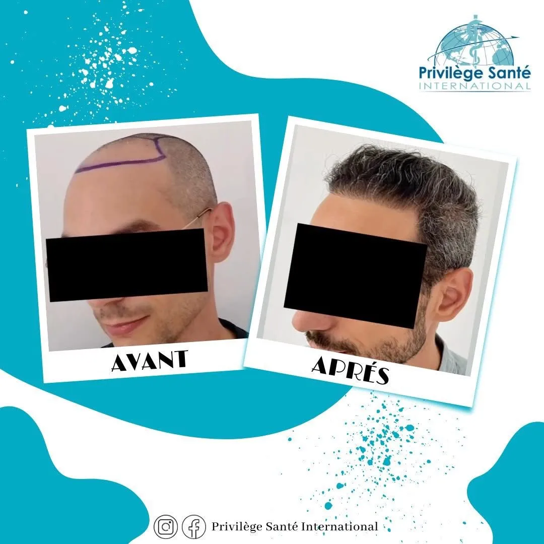 Greffe de cheveux Tunisie