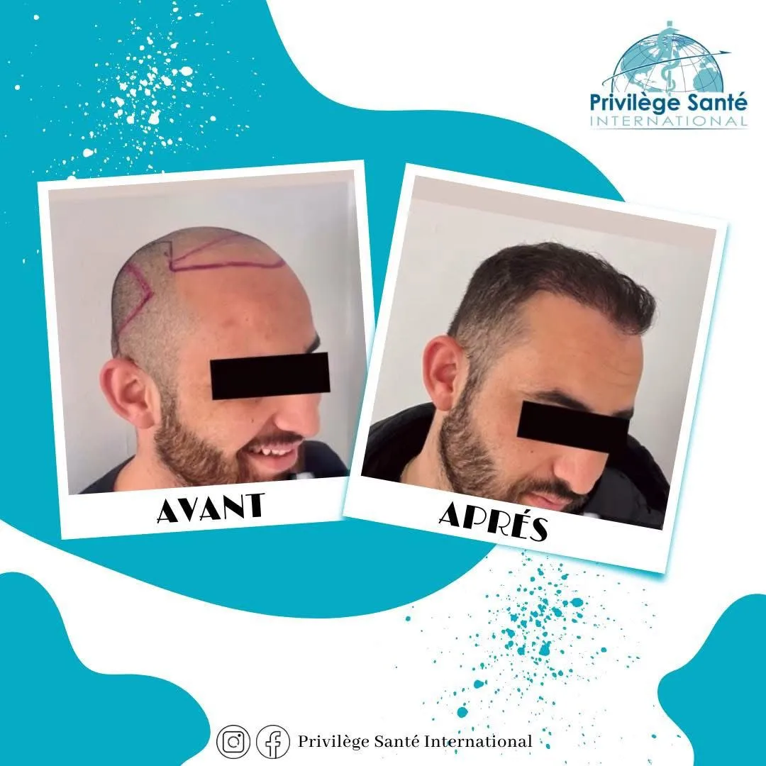 Greffe de cheveux Tunisie