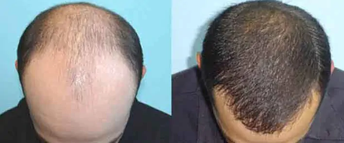 Hair transplant Tunisia