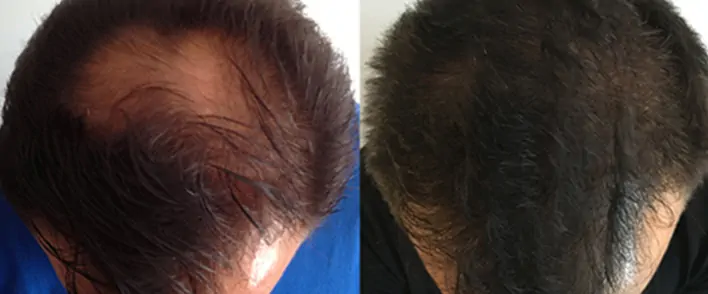 Hair transplant Tunisia