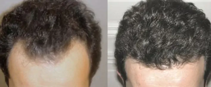 Hair transplant Tunisia