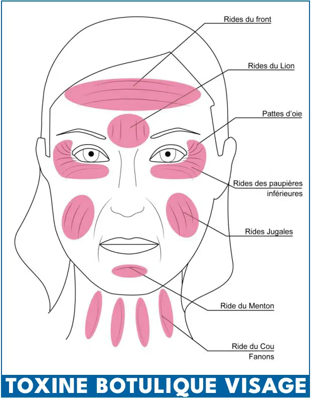 Toxine botulique visage Tunisie