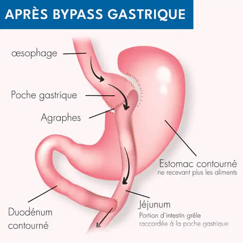 Après bypass gastrique Tunisie