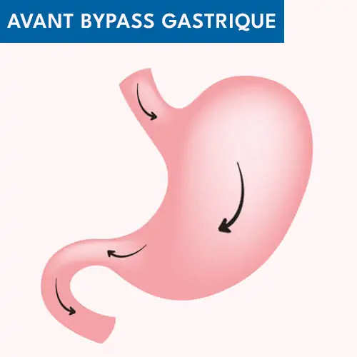 Avant bypass gastrique Tunisie