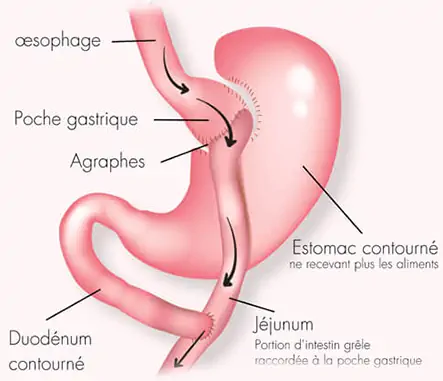 Gastric Bypass Tunisia