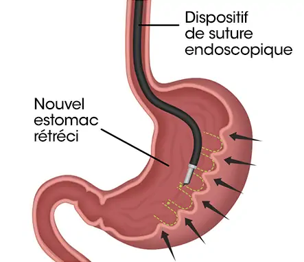 Endo-sleeve Tunisie et Turquie