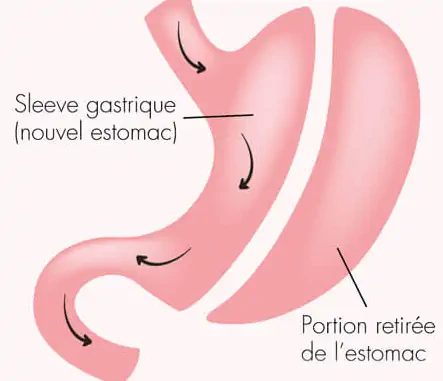 Gastric sleeve Tunisia